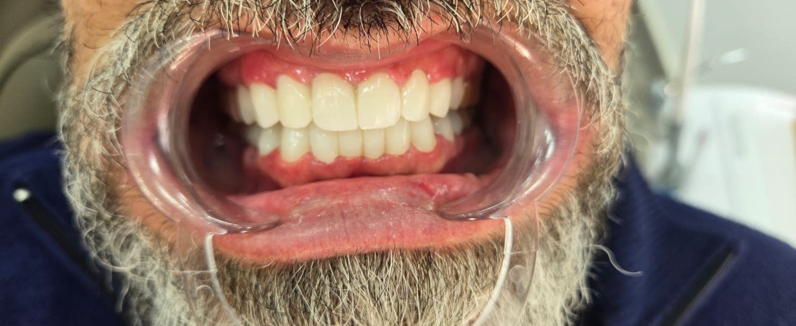 Лечение и реставрации — после лечения