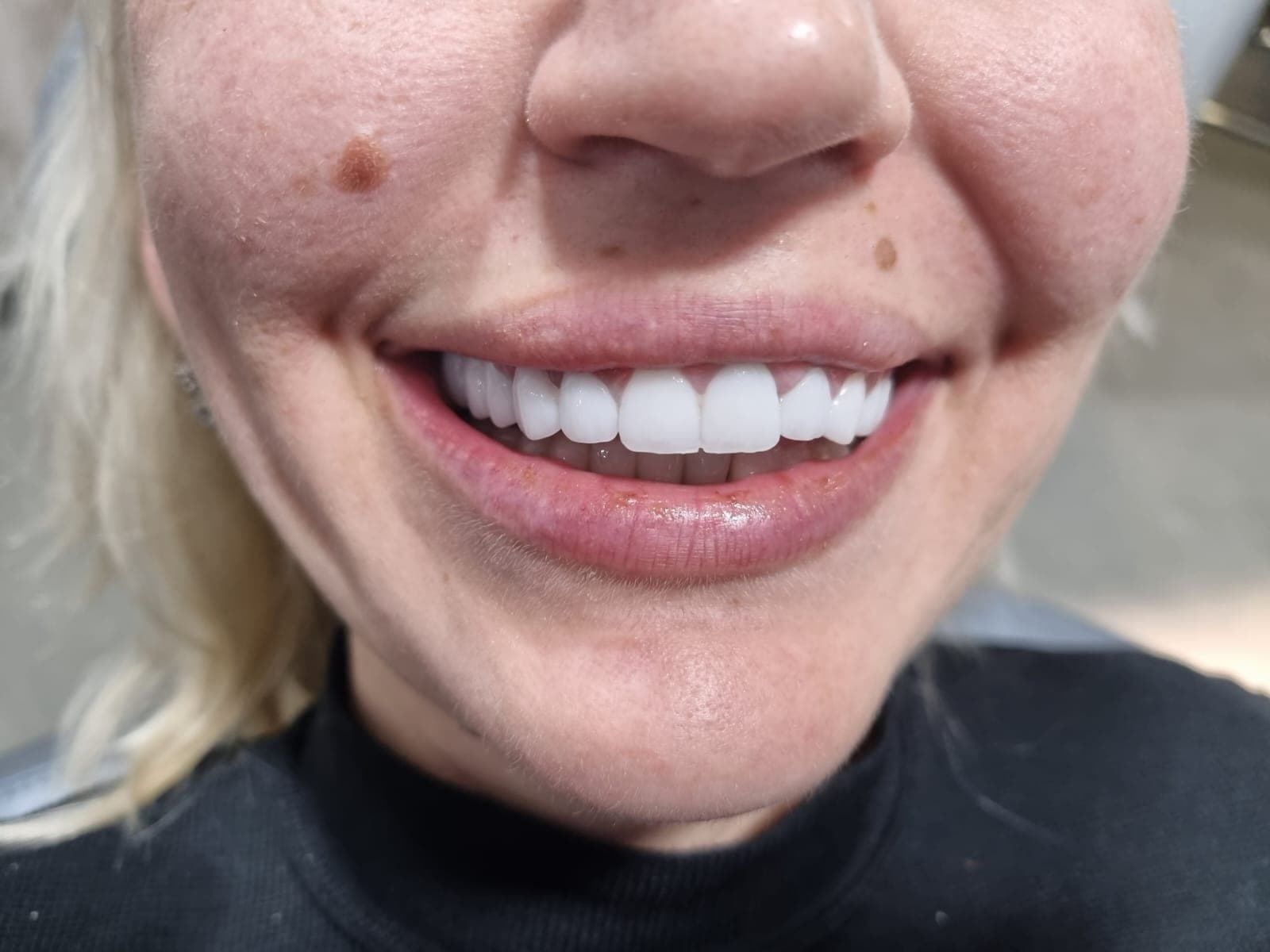 Результат эстетического лечения в Sofia Dent